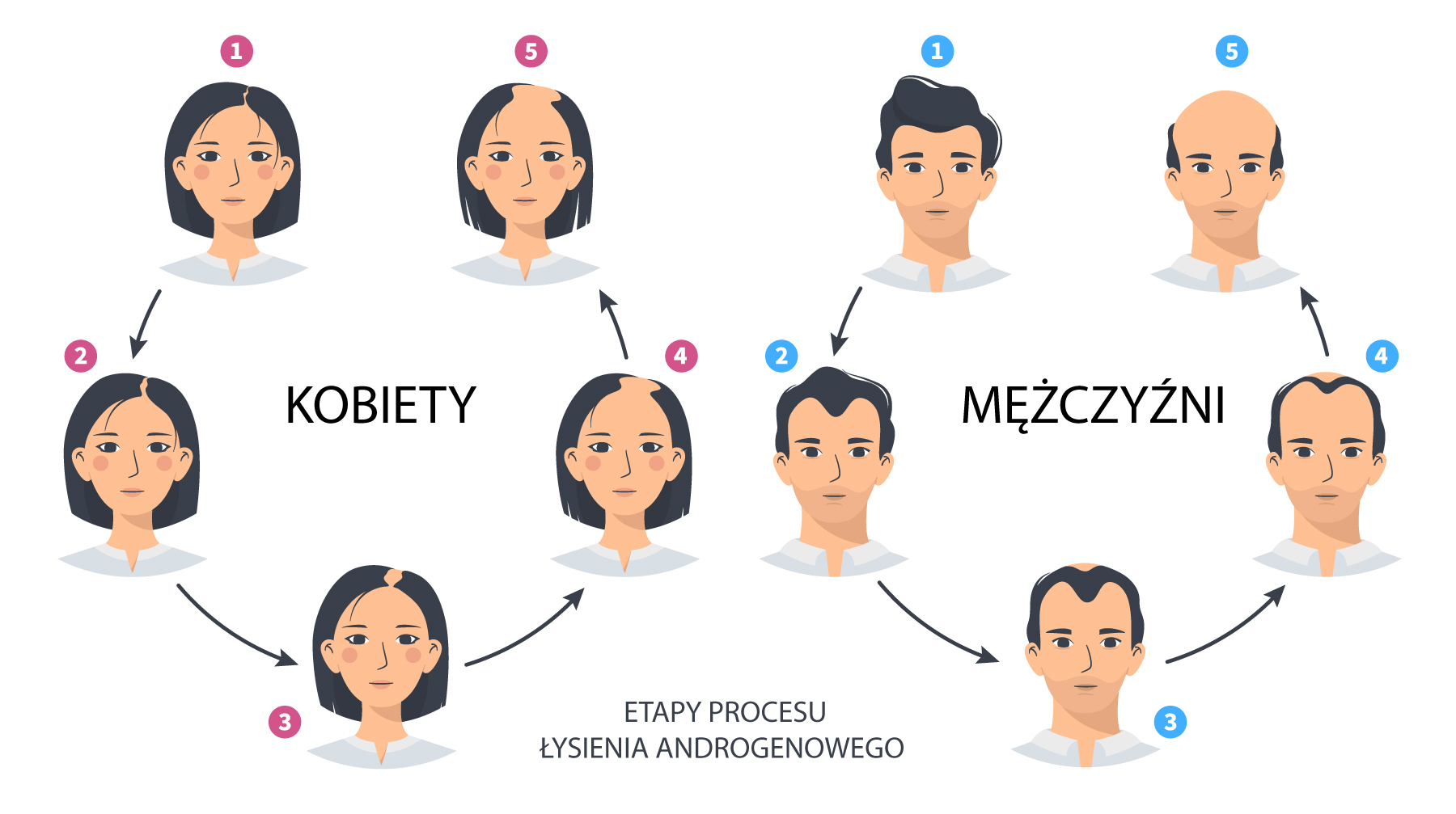 Etapy łysienia androgenowego u kobiet i mężczyzn