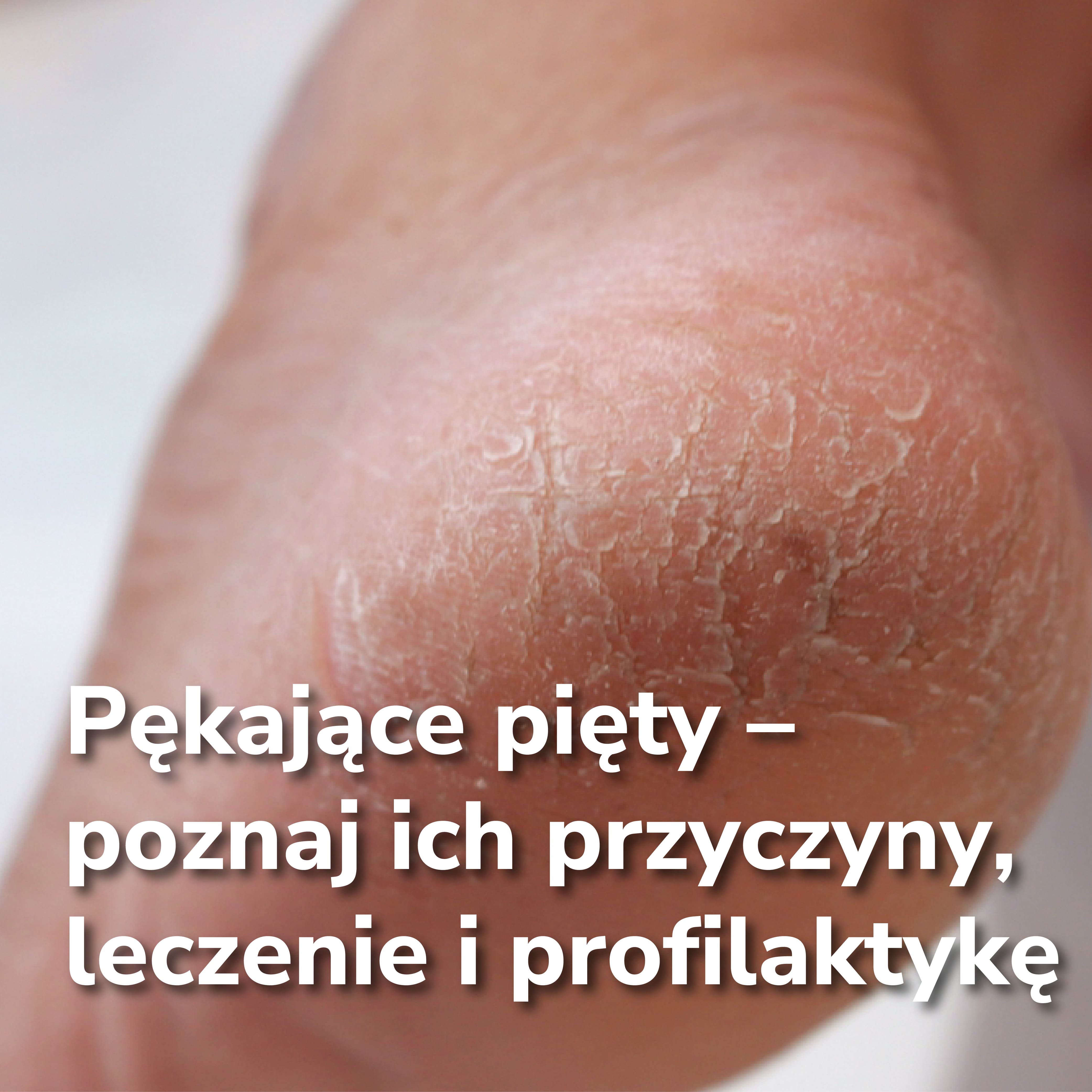 Pękające pięty – poznaj ich przyczyny, leczenie i profilaktykę