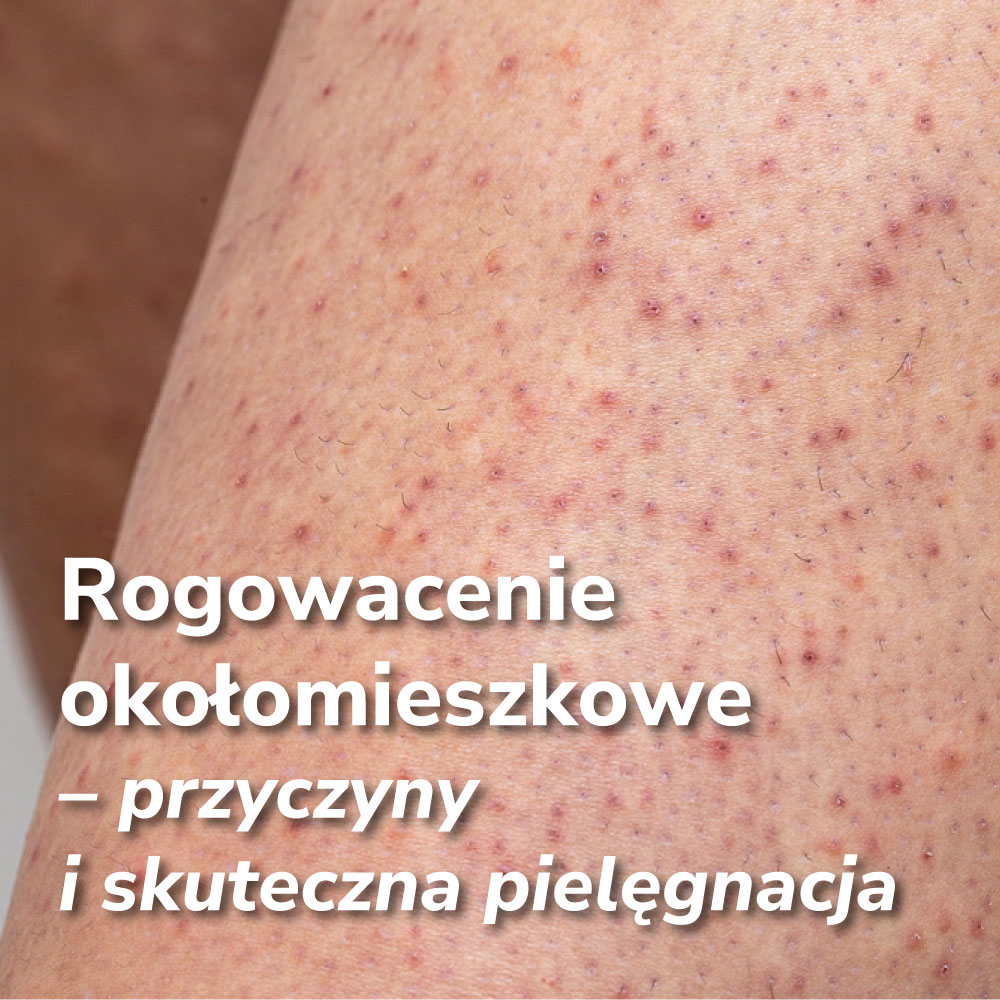 Rogowacenie okołomieszkowe – skąd się bierze i jak skutecznie wygładzić skórę?