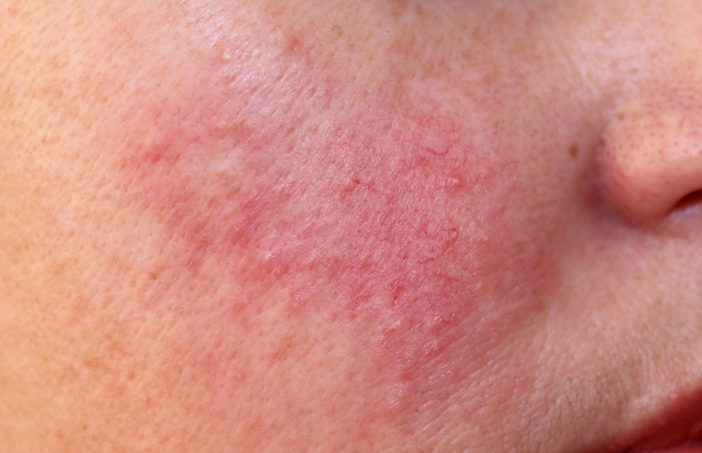 Rosacea (trądzik różowaty) – przyczyny, objawy i dobór pielęgnacji